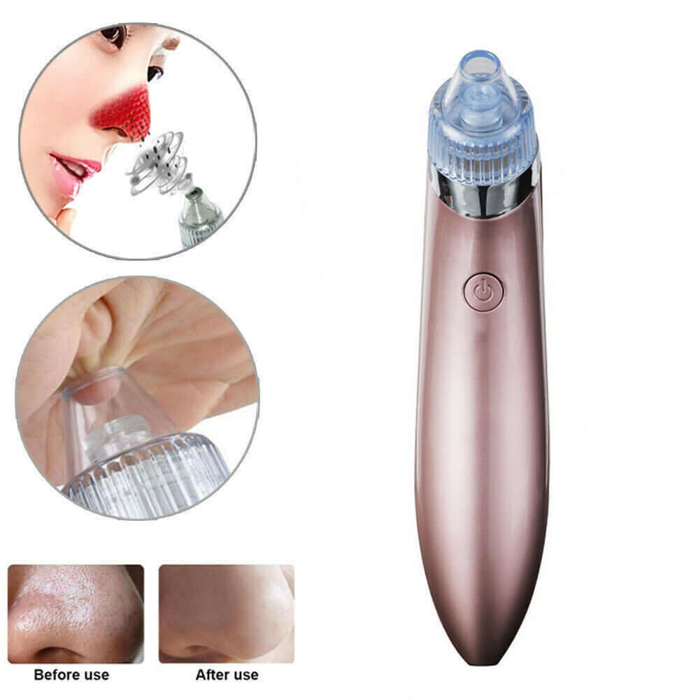 Electric Blackhead Vacuum: Pore Cleaner, Acne Remover & Diamond Dermabrasion Tool