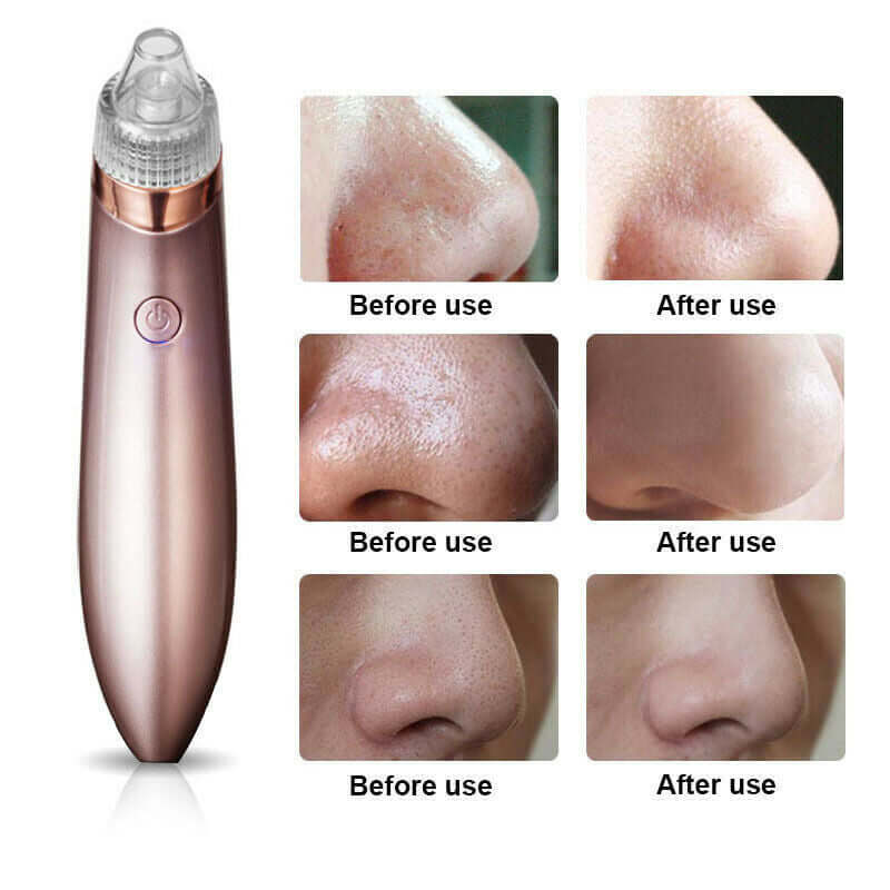 Electric Blackhead Vacuum: Pore Cleaner, Acne Remover & Diamond Dermabrasion Tool